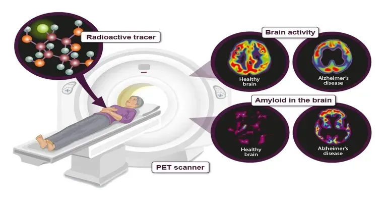 The question was, and still is, when will we have a treatment for Alzheimer's? The answer is now.