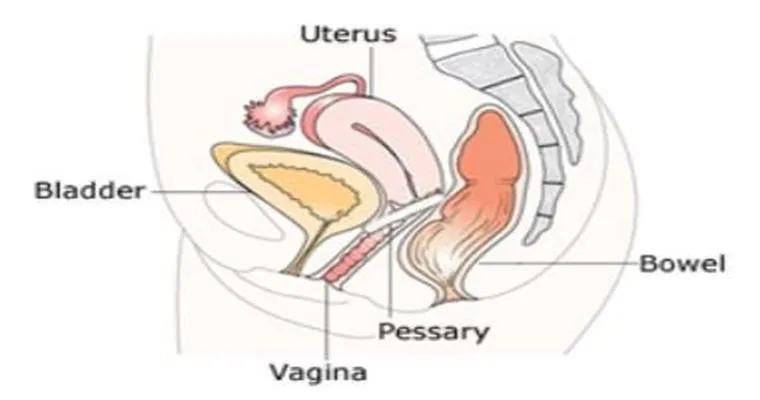 Are there any new pessaries that are easier to use than what they have available now? I was given one for a prolapsed bladder, so hard to use.