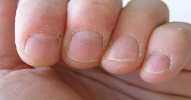 Fingernails: 5 Signs That Point to Senior Health Problems