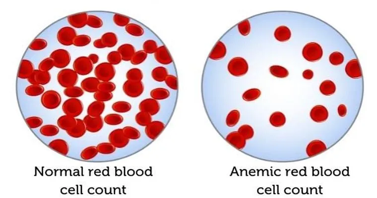 Anemia in Seniors: What to Look for and How to Treat It