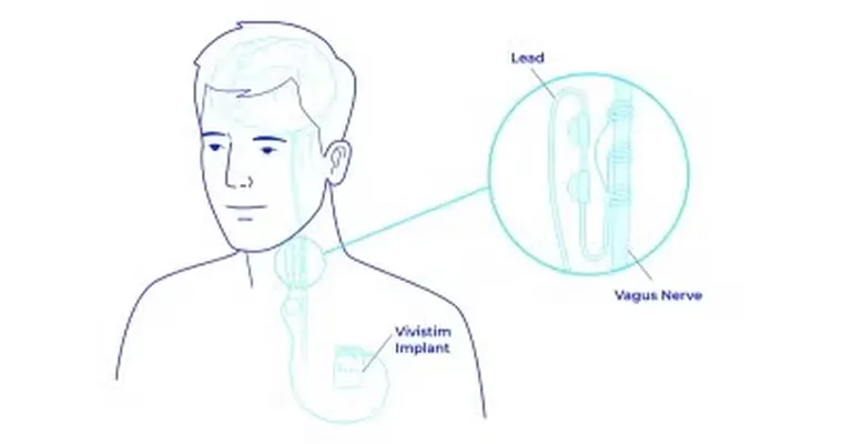Does anyone have info regarding Vivisitim for stroke survivors?