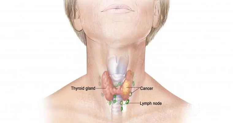 Terminal thyroid cancer. Any advice?
