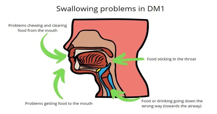 Chewing and swallowing problems.