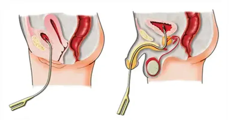 My husband does self catheterization. I empty used catheters daily and spray with Lysol. Do I need to do more to keep the odor down?