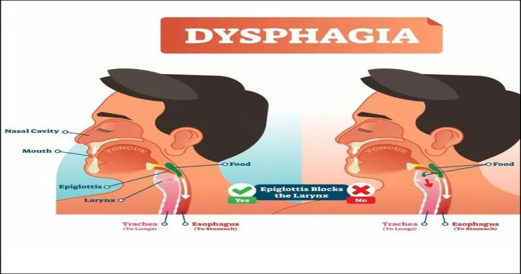 Losing the Ability to Swallow: How to Help Someone With Dysphagia